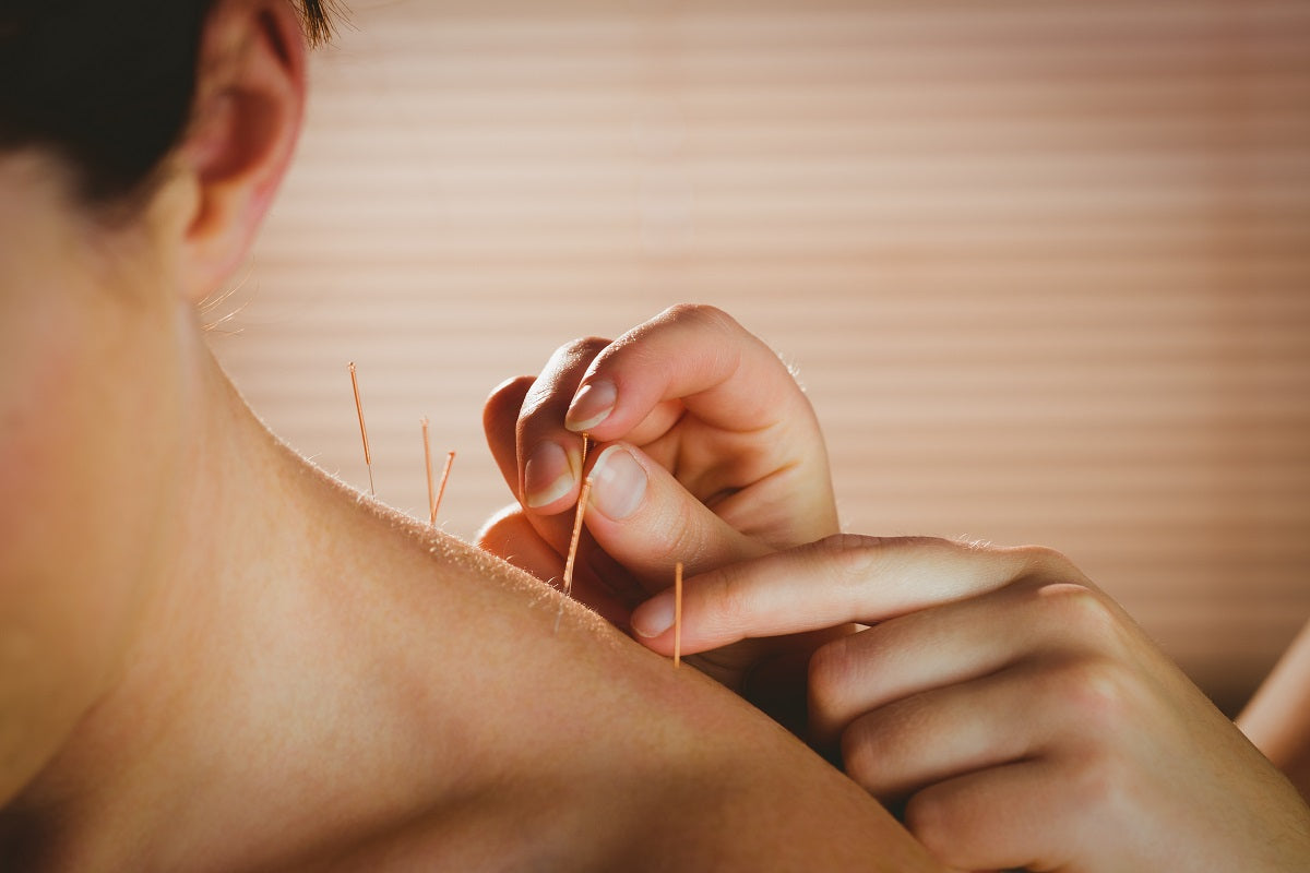 Acupuncture: An Ancient Healing Practice