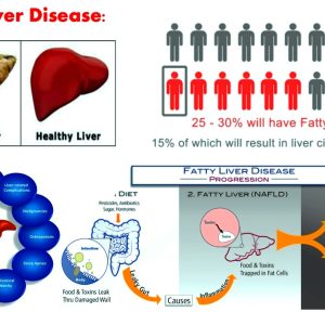 The Power of Nutrients in Combating Fatty Liver