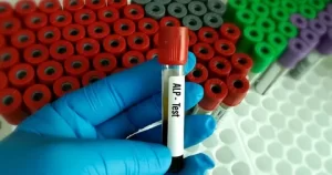 Understanding Alkaline Phosphatase A Vital Blood Biomarker